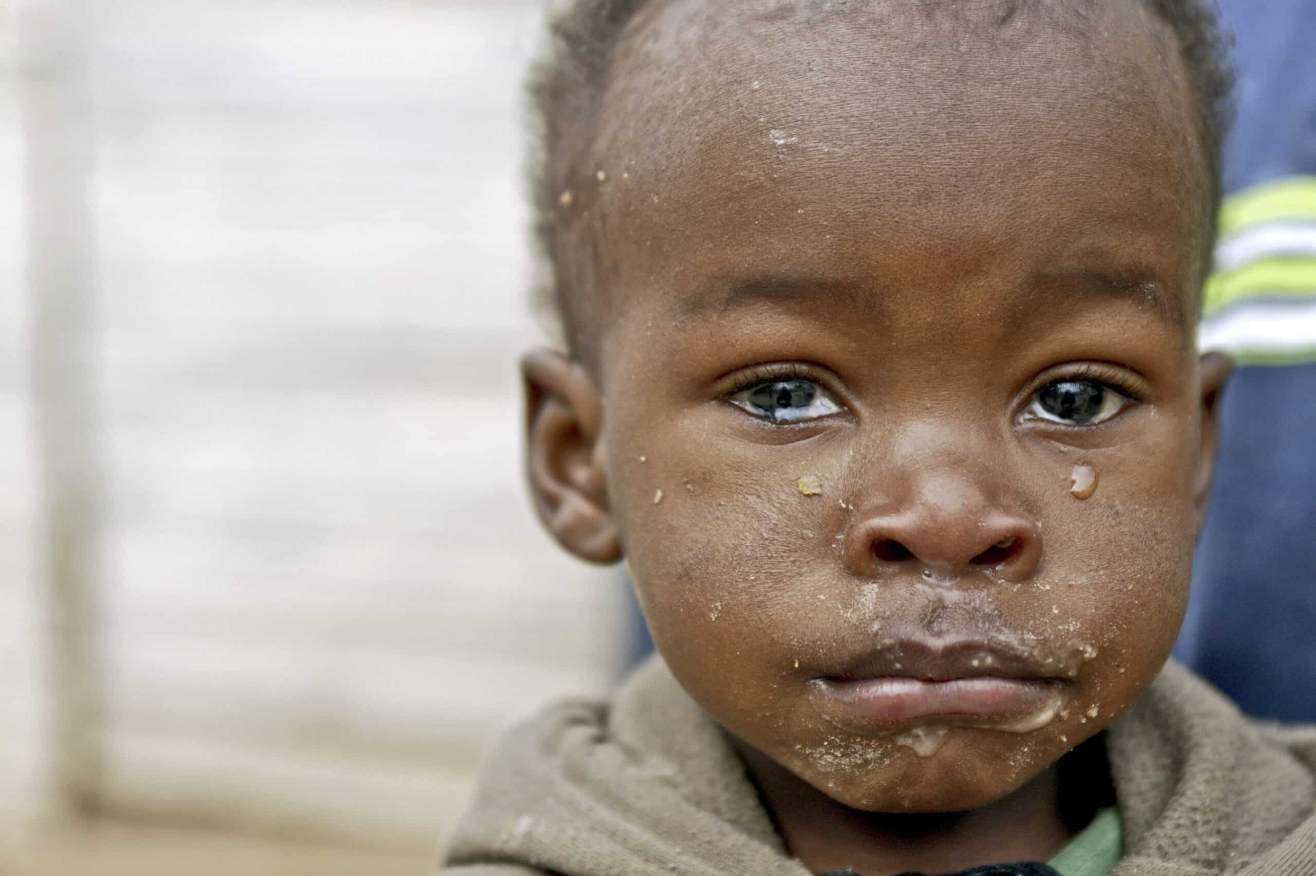 Eine Nahaufnahme eines kleinen Kindes mit tränenden Augen und schmutzigem Gesicht, das vor einem unscharfen Hintergrund direkt in die Kamera blickt. © Fotografie Tomas Rodriguez